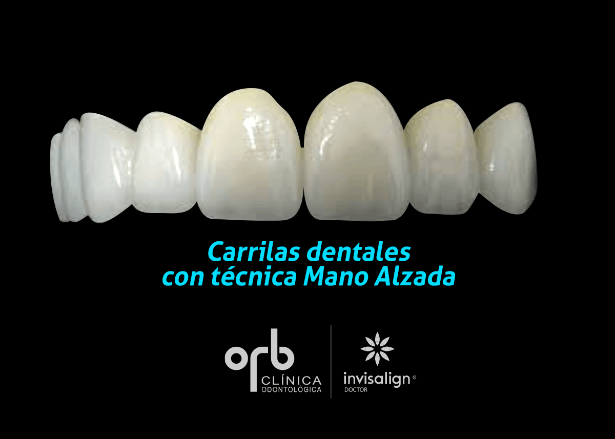 Carillas dentales - Odontología Ricardo Beltran